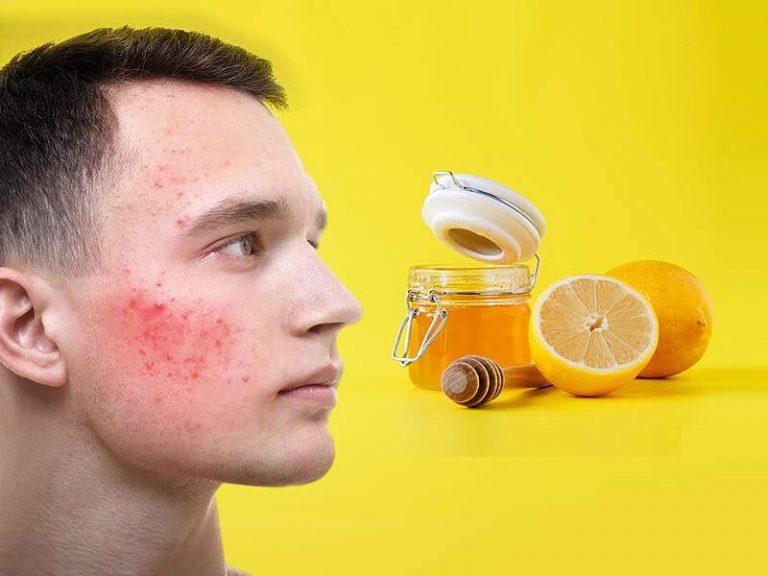 DIY Honey and Lemon Mask For Acne Scars 365