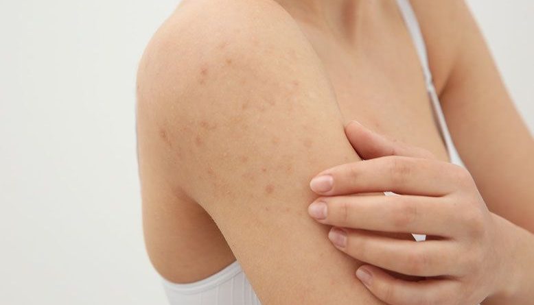 How to Get Rid Of Pimples After Waxing Arms