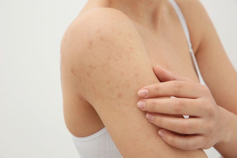 How to Get Rid Of Pimples After Waxing Arms