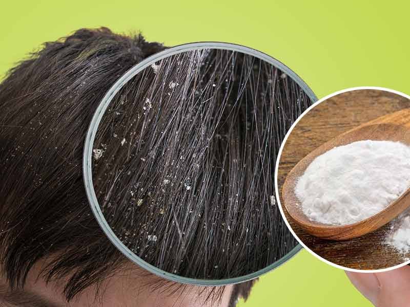 baking soda for dandruff