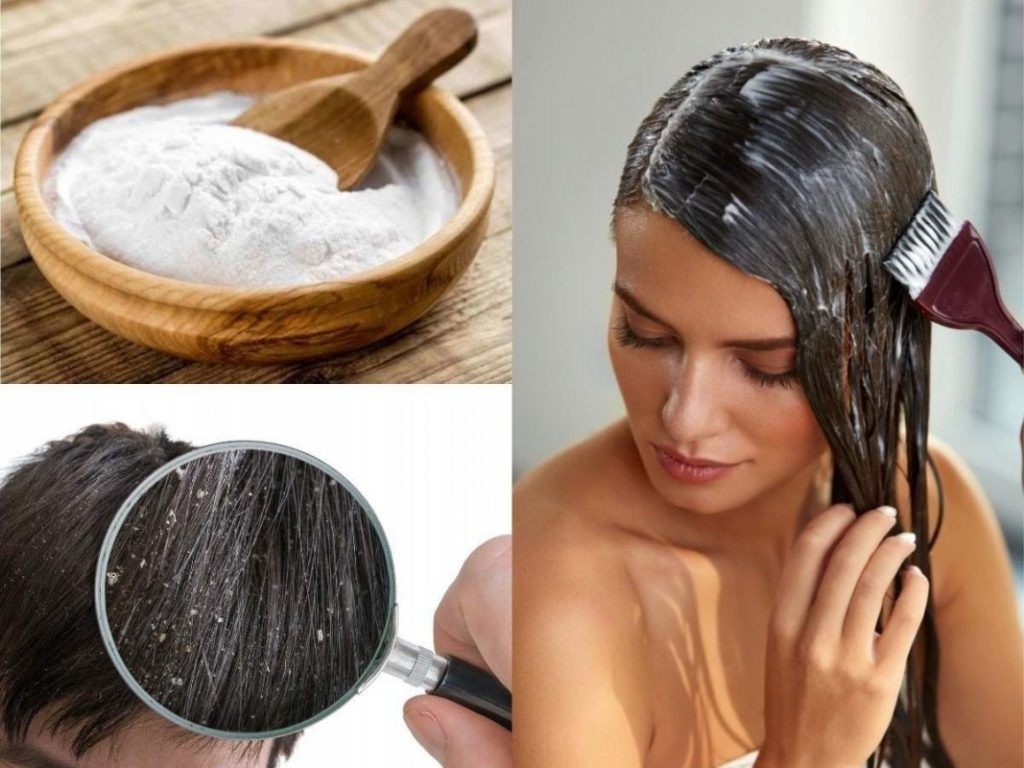 baking soda for dandruff