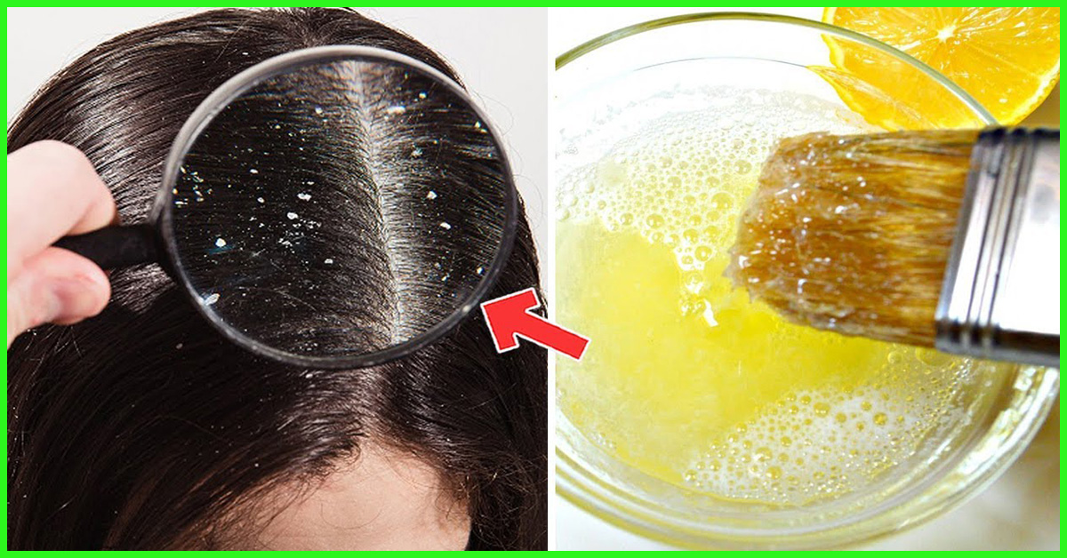 How to Remove Dandruff in One Wash?