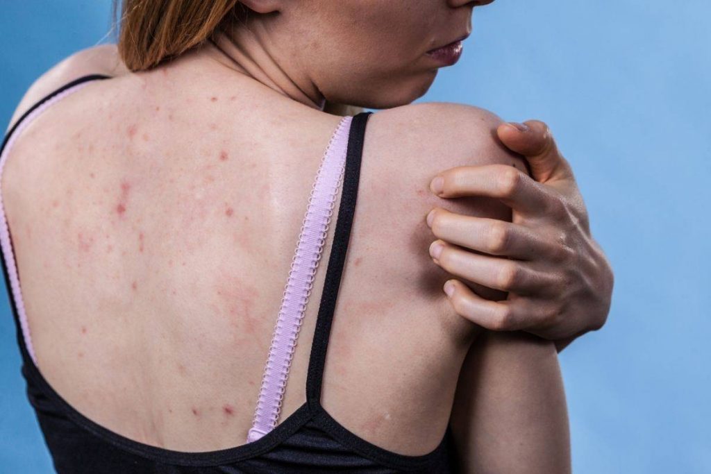 acne on shoulders